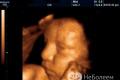 Ultrasound for pregnant women What ultrasound screening shows
