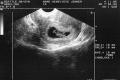 Mitu korda ja kuidas tehakse rasedate planeeritud ultraheli? Millises raseduse staadiumis plaanilist ultraheli tehakse?