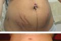 How to avoid stretch marks during pregnancy, effective ways and prevention