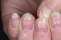Как определить болезнь по ногтям - фото Болезнь по ногтям пальцев рук
