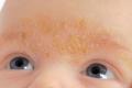 Hvorfor skaller huden på panden af ​​hos børn og voksne?